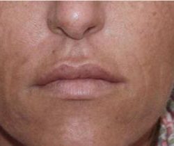 Secret RF Before & After Patient #1620